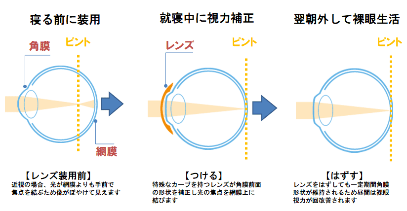 オルソケラトロジ ー やめた あと